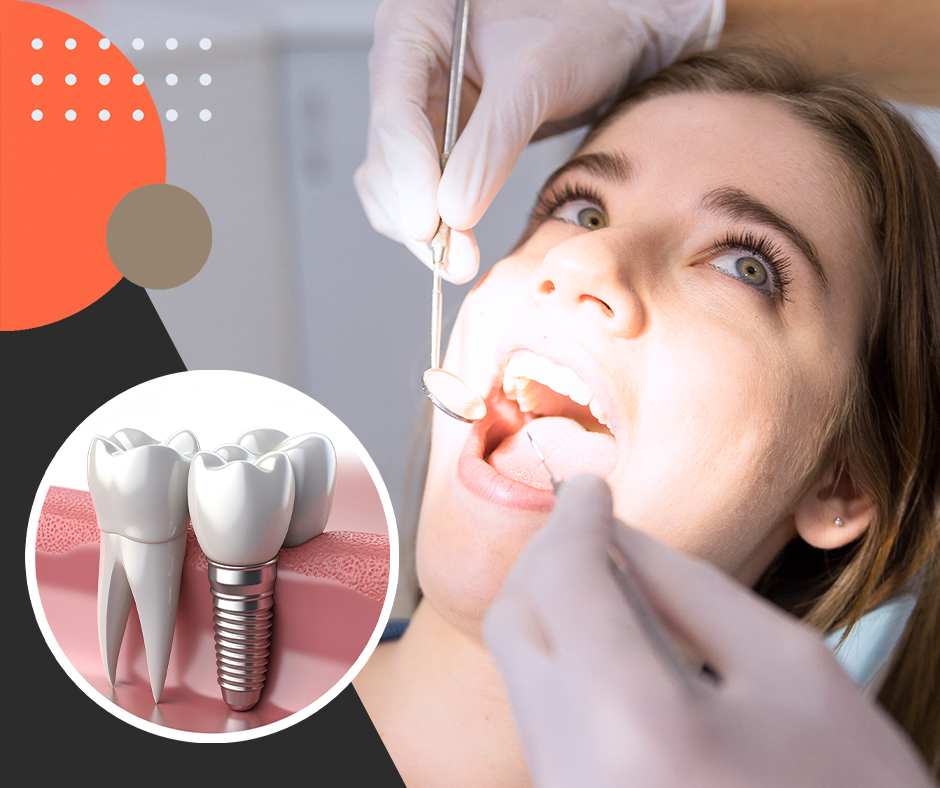 Tips and Tricks to Take Care of Dental Implants