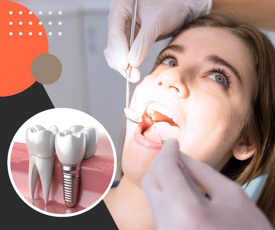 Top Tips and Tricks to Take Care of Dental Implants