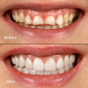 Do Dental Crowns Look Natural_One Two Three Dental