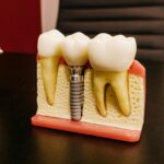 Choosing the Right Root Canal Specialist in Bradford