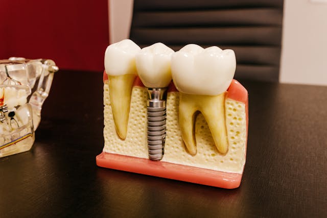 How Much Do Dental Implants Cost in Bradford - Eccleshill Dental guide